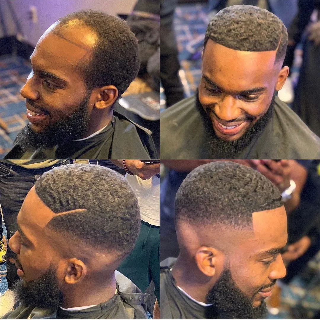Four views of a hair restoration result