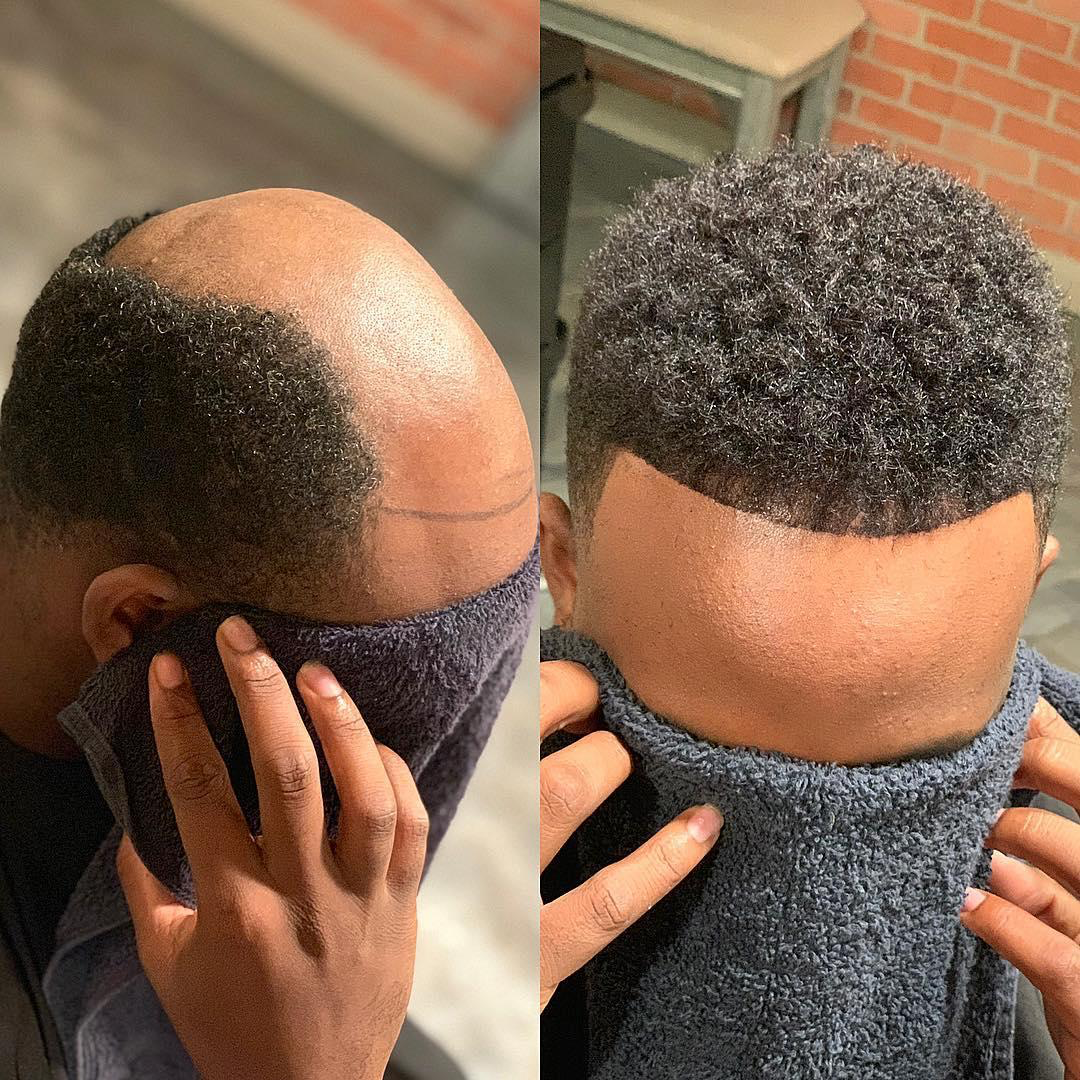 Before and after hair restoration result